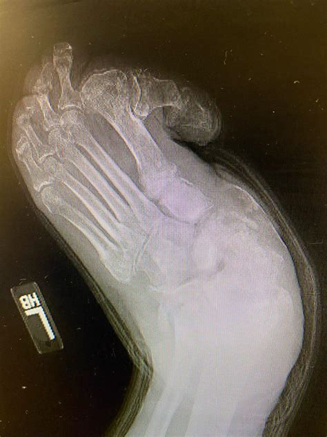 Deformed Foot Rradiology