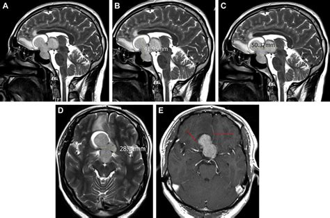 E A T2 Sagittal Mri Showing The Trilobed Giant Pituitary Adenoma With