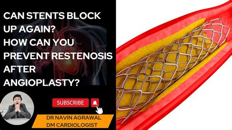 Angioplasty Success Avoiding Stent Restenosis Proven Tips YouTube