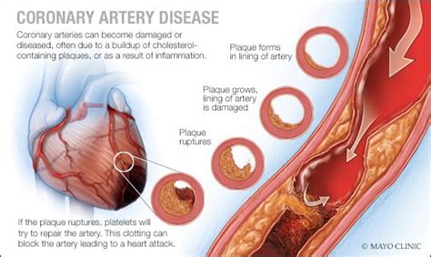 coronary artery disease lingard private hospital