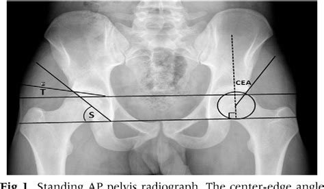 Figure 1 From Age Related Differences In Radiographic Parameters For