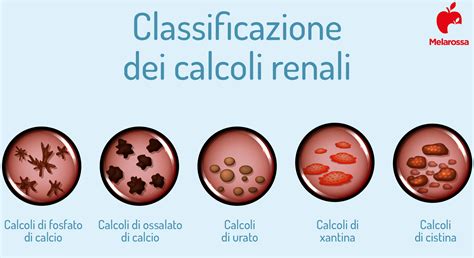 Calcoli Renali Cosa Sono Sintomi Cause Diagnosi Cura E Prevenzione