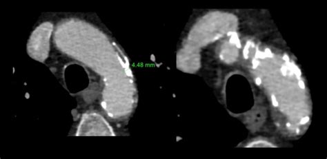 Aortic arch atherosclerosis | STROKE MANUAL