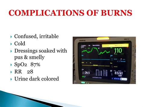 Complications Of Burns Ppt