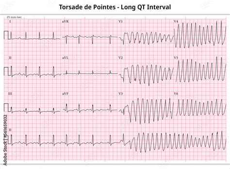 Ecg Prolonged Qt Torsade Hot Sex Picture