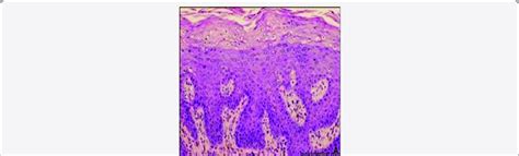 Focal Epithelial Hyperplasia Demonstrating Acanthotic Stratified