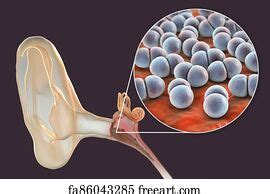 Free Art Print Of Otitis Media Inflammatory Disease Of The Middle Ear