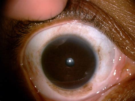 Tumores Melanocíticos Da Conjuntiva Entenda Os Principais Diagnósticos