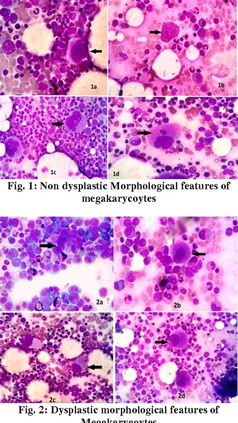 Figure 1 From Bone Marrow Aspiration Study Of Megakaryocytic