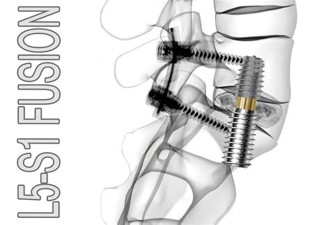 What is L5-S1 Fusion Surgery?