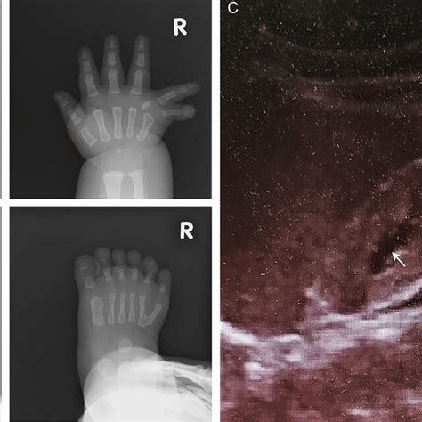 At Birth The Radiographs Show Postaxial Polydactyly On Both Hands A