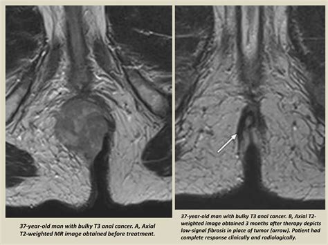 Presentation Radiological Imaging Of Anal Carcinoma PPTX