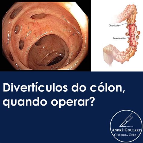 Quem Tem Diverticulite Pode Fazer Colonoscopia - André Goulart - Cirurgia Geral - • Se fez uma colonoscopia e no ...