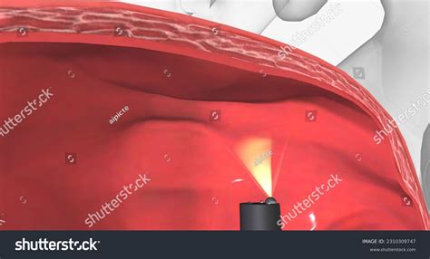 897 Bladder Biopsy Images Stock Photos And Vectors Shutterstock