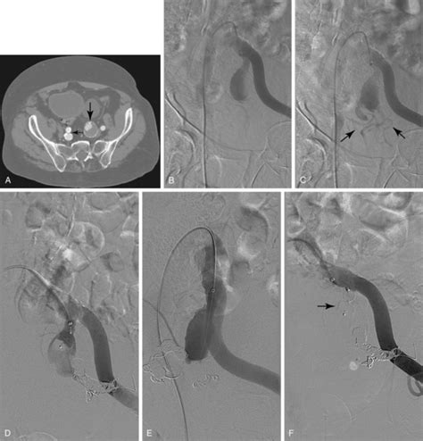 Abdominal Aorta Radiology Key