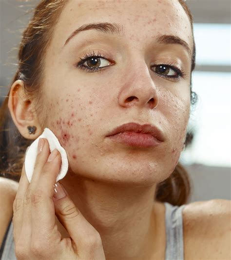 Face Mites Causes Diagnosis Treatment And Home Remedies