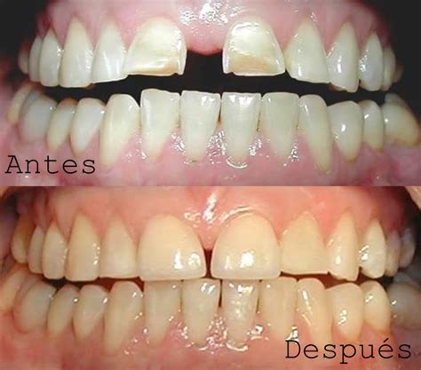 Dise O De Sonrisas Cl Nica Dental Dentart Las Condes Providencia