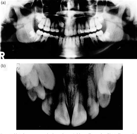 Figure From The Radiographic Localization Of Impacted Maxillary