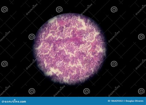 carcinoma neuroendocrino moderadamente diferenciado carcinoide atipico