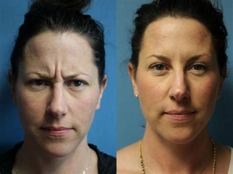 dysport how long does it take to work