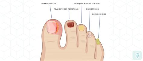 Лечение грибка ногтей народными средствами - Медицинский справочник