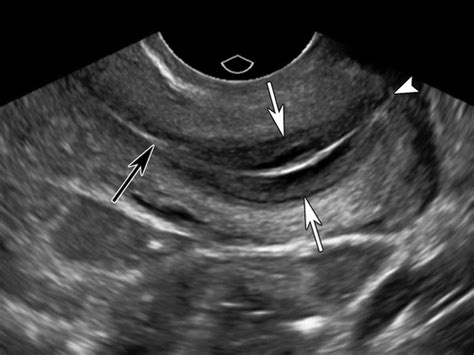 The Fluid In Cervical Canal