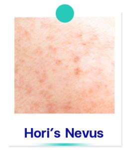 freckles sun  dark spots bangkok aesthetic clinic
