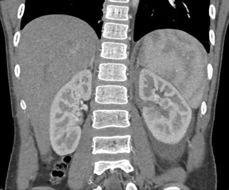 Renal Laceration Left Kidney Kidney Case Studies Ctisus Ct Scanning