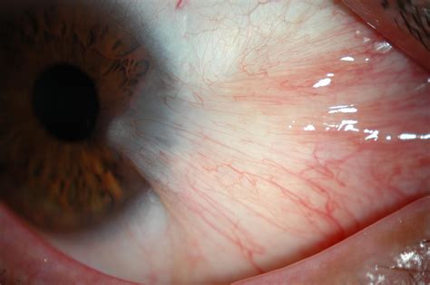 Pterygium Miranza