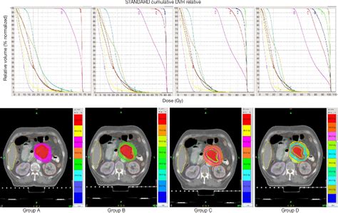 Dosimetric Feasibility On Hypofractionated Intensity Modulated Radiotherapy And Simultaneous