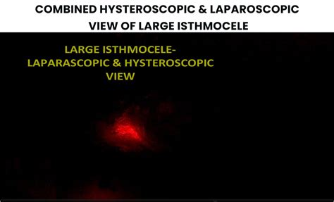 A 30 Year Old Female Patient Underwent Laparoscopic Isthomocele Repair