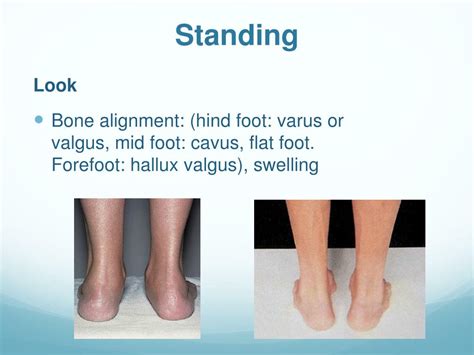 Ppt Foot And Ankle Examination Powerpoint Presentation Free Download