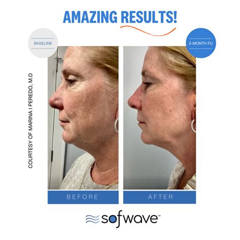 Sofwave Skin Lifting Tightening