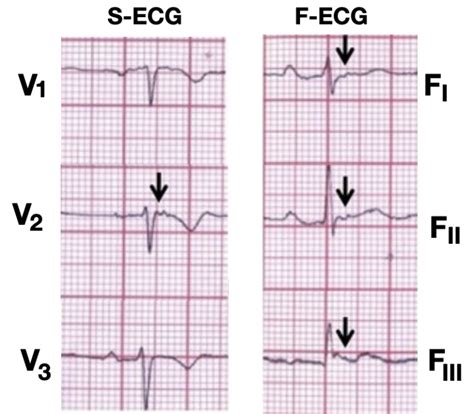 Epsilon Wave • Litfl Medical Blog • Ecg Library Basics