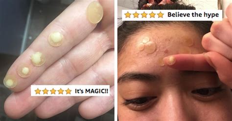 Before And After Pimple Patches Uk Pre Brunofugaadvbr
