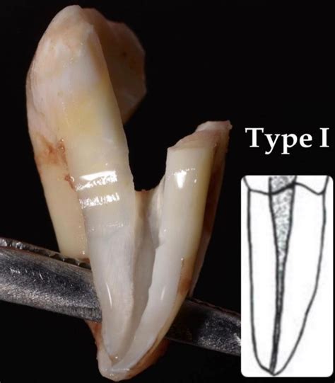 Rotfyllning Endodonti Tandl Kare Stockholm Svea Tandklinik