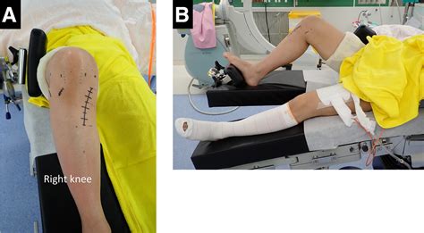 Combined Procedure Of Arthroscopic Pullout Medial Meniscal Root Repair