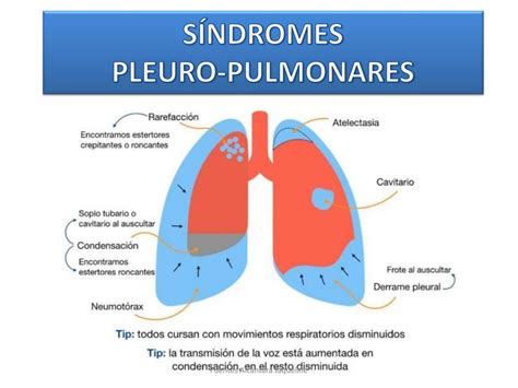 Síndromes Pleuro Pulmonares Yaki Alcantara uDocz