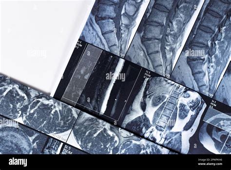 Copy Of Magnetic Resonance Imaging Of Human Spine Stock Photo Alamy