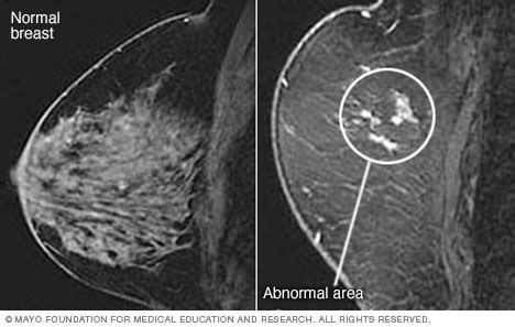 Breast MRI Results Mayo Clinic