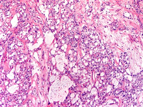 Wilms Tumor Pathology Outlines 5