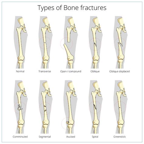 Understanding Bone Fractures