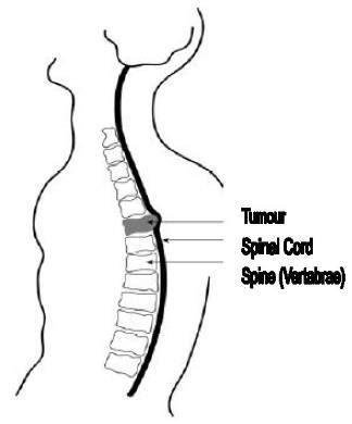 Metastatic Spinal Cord Compression MSCC Milton Keynes University