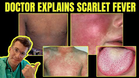 Doctor Explains Scarlet Fever Group A Streptococcal Disease Causes