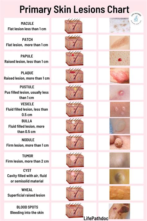 Skin Lesions: Types with Chart, Pictures, Causes, Treatment