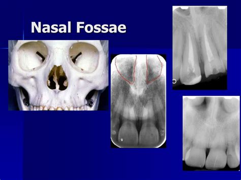 Incisive Fossa Of Mandible