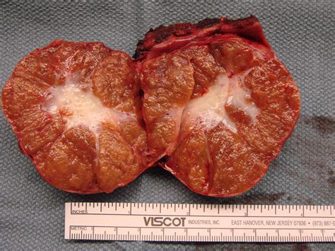 Focal Nodular Hyperplasia Liver