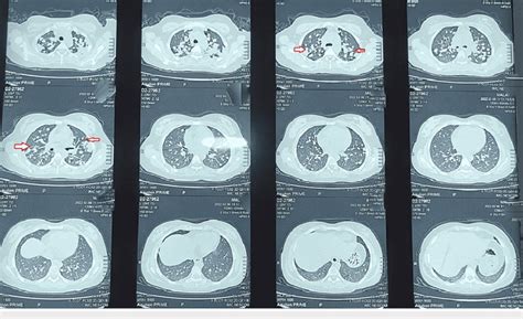 Chest CT scan showing infiltrates in both lung fields. Arrows point... | Download Scientific Diagram