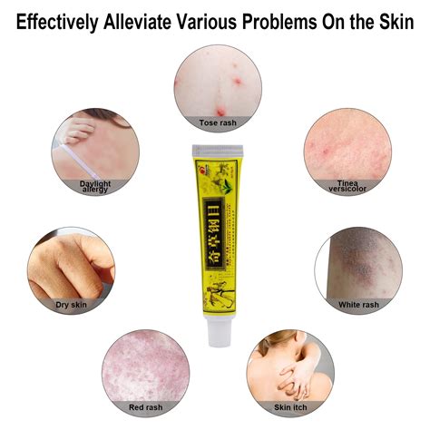 Buy 5PCS Natural Chinese Herbal Eczema Cream Psoriasis Creams