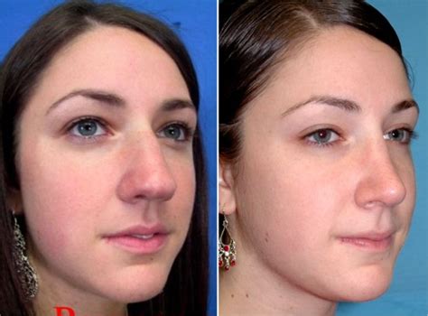 Rhinoplasty Can Reduce The Size Of The Nose Or Alter The Shape Of The